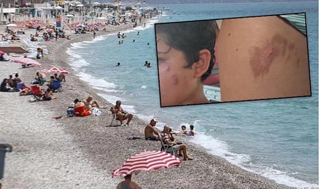 Akdeniz'de denize giren yanıklarla çıkıyor! Uzmanlardan uyarı geldi